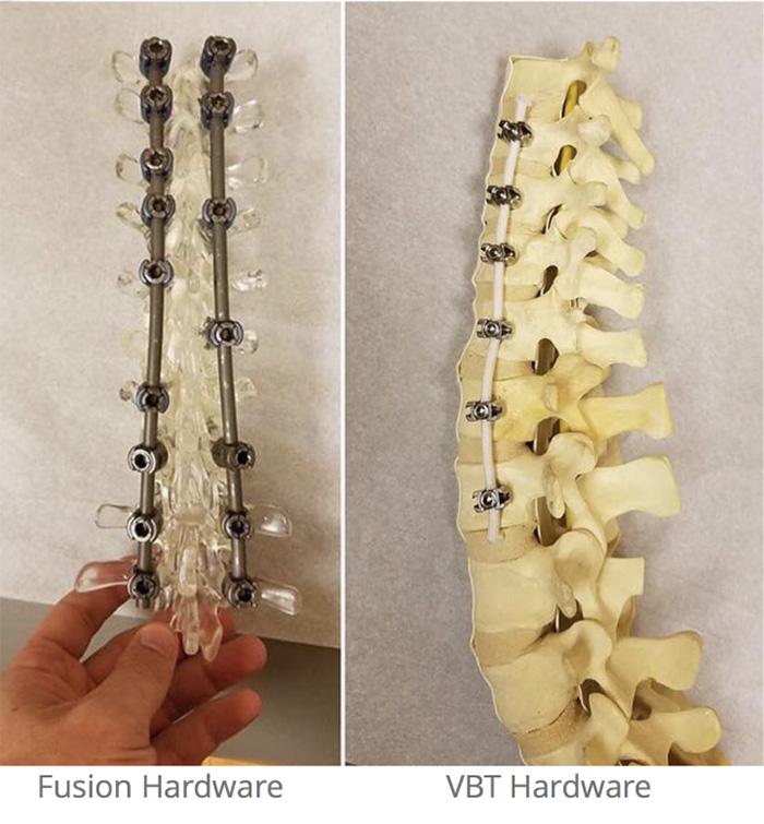 Anterior Vertebral Body Tethering (AVBT) Columbia Orthopedic Surgery