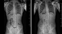 After and before spine x-ray images