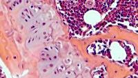 Microscopic image of a musculoskeletal oncology pathology sample.