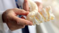 3D printed model of a severe spinal deformity