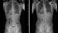 After and before spine x-ray images